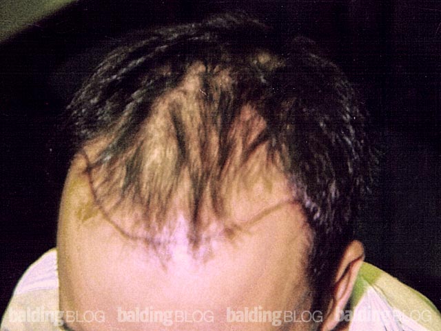 Tramadol Vs Codiene Diazepam Metabolite Amoxicillin And Diarrhea