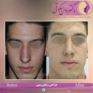 جراحی زیبایی بینی