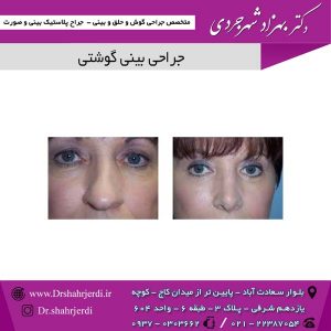 جراحی بینی گوشتی
