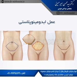 عمل ابدومینوپلاستی