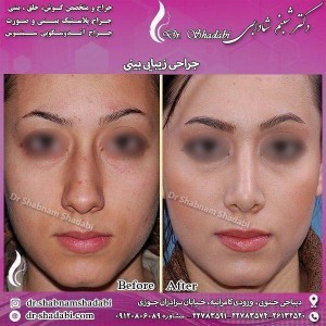 بهترین جراح بینی تهران